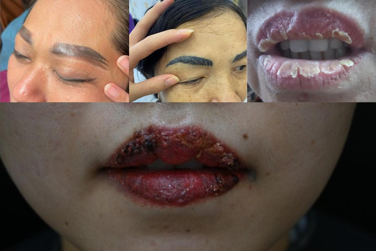 Bệnh Lây Qua Máu Trong Phun Xăm, Quy Trình An Toàn 2 Rủi ro trong phun xăm thẩm mỹ: Đâu là giải pháp khắc phục an toàn và hiệu quả?