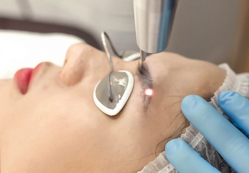 5 Cách Xóa Sửa Dáng Mày Cũ Hỏng Cho Người Muốn Mở Tiệm 6 XÓA CHÂN MÀY BẰNG CÔNG NGHỆ LASER LÀ GÌ ? XÓA BẰNG CÔNG NGHỆ LASER CÓ