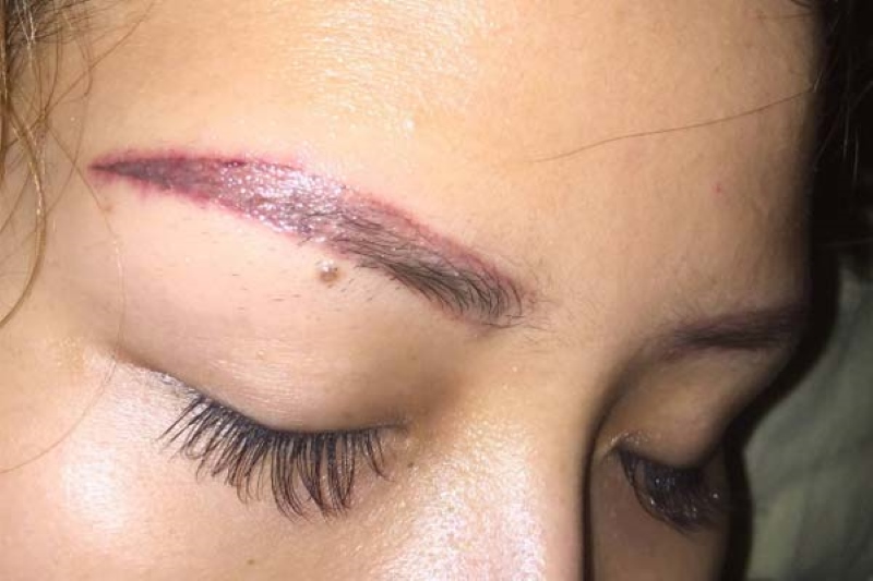 Cách Xử Lý Chân Mày Trổ Xanh Đỏ Mở Tiệm Kinh Doanh 6 Vì sao lông mày trổ xanh trổ đỏ? Cách xử lý hiệu quả nhất