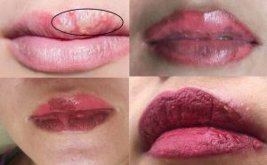 Ngộ độc và dị ứng thuốc tê khi xăm môi sẽ phải đối diện với nguy cơ gì? -  Nhà thuốc FPT Long Châu