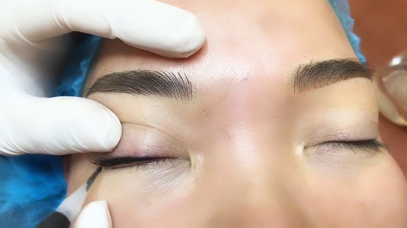 Cách Xử Lý Mí Mắt Bị Trổ Xanh, Nguyên Nhân và Giải Pháp 6 Phun mí mắt bị trổ xanh: Nguyên nhân và cách khắc phục