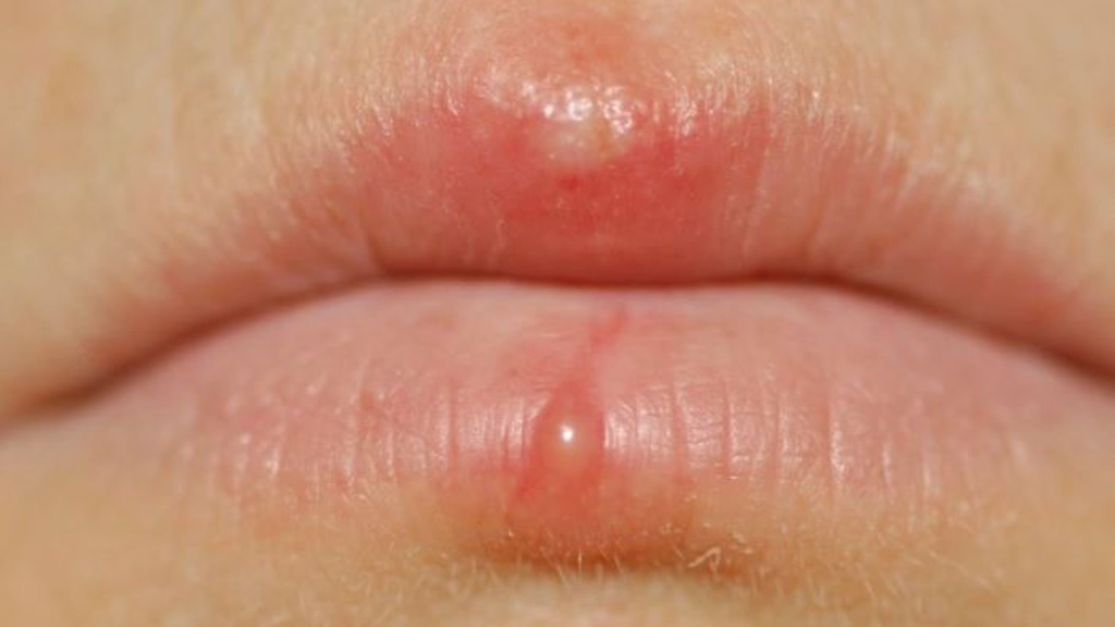 Phun Môi Bị Nổi Mụn Nước, Nguyên Nhân và Cách Xử Lý 5 Phun môi bị mụn nước: Nguyên nhân và hướng xử lý