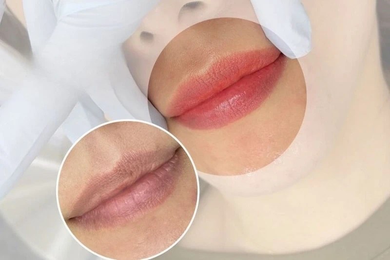 Quy Trình Xử Lý Môi Thâm Trước Khi Phun Cho Người Mới 2 Khử thâm môi là gì? Phương pháp và quy trình hiệu quả nhất